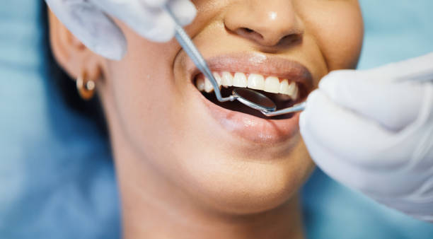 Best Knocked-Out Tooth (Avulsed Tooth) Treatment in Swartz Creek, MI
